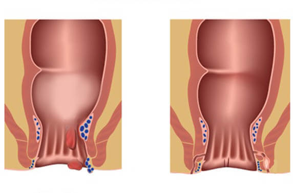 Proktologische Eingriffe Proktologie in Berlin - Chirurgicum Berlin Dr. Sezgin & Dr. Wit