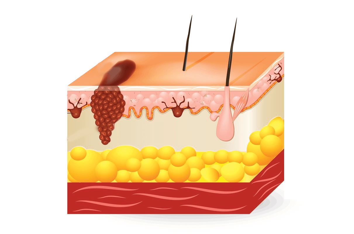 Hautchirurgie im Chirurgicum Berlin Dermatologische Chirurgie Berlin