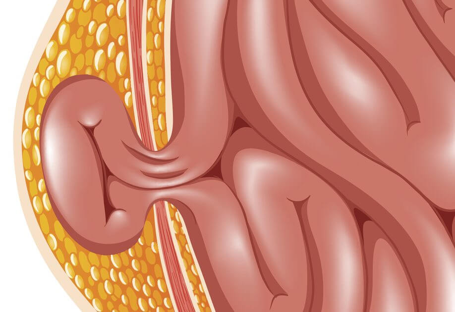 Leistenchirurgie Chirurgicum Berlin Leistenbruch OP